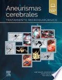 Aneurismas cerebrales