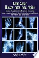 Como curar huesos rotos más rápido. Consejos para curar fracturas de huesos: Aprenda sobre los alimentos para la curación de fracturas, los tipos de f